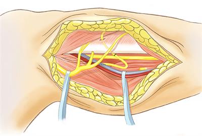 Transfer of Soleus Muscular Branch of Tibial Nerve to Deep Fibular Nerve to Repair Foot Drop After Common Peroneal Nerve Injury: A Retrospective Study